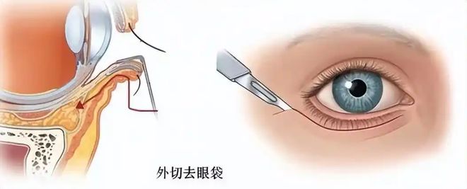 技术？拉皮手术面部提升无锡苏州杭州J9国际网站去除眼袋有什么比较好的(图3)